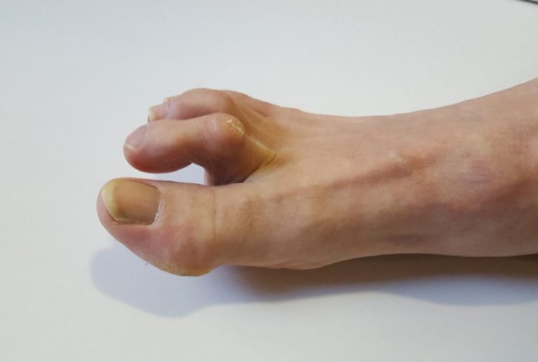 Image de :How to prevent or relieve hammertoes?