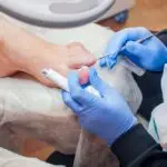 Traitement des ongles incarnés