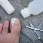 La chirurgie d’ongle incarné
