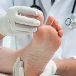 Le pied d’athlète (tinea pedis)