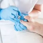 L’ongle traumatique : symptômes et traitements