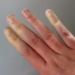 La maladie de Raynaud
