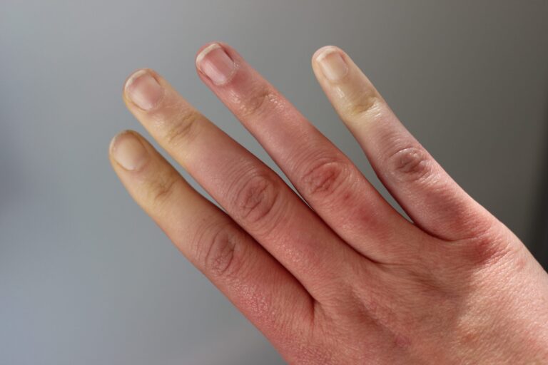 Image de :La maladie de Raynaud