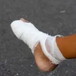 Partial or complete foot amputation