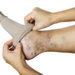 Insuffisance veineuse dans les jambes