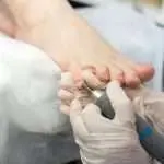 Traitement des ongles d’orteils épais et difformes