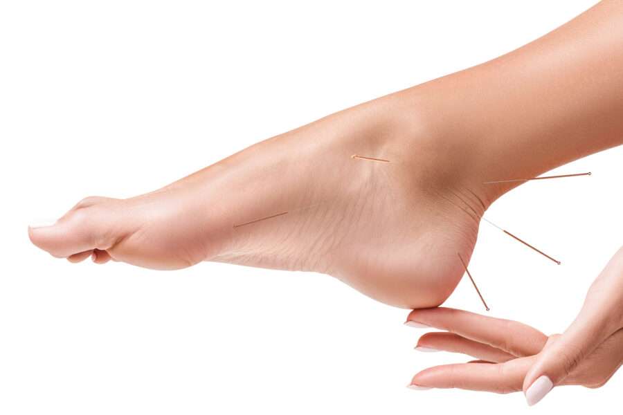 Image de :Acupuncture des pieds : tout ce qu’il faut savoir