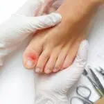 Que faire si on s’arrache un ongle d’orteil?  