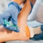 L’injection de PRP (plasma riche en plaquettes) au pied pour la fasciite plantaire et les tendinites