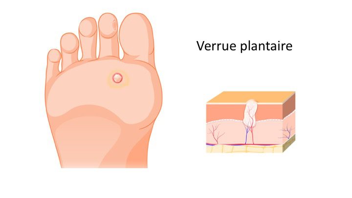 Image de :Comment traiter ma verrue plantaire à la maison ?